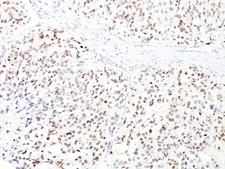 MITF Antibody - Formalin-fixed, paraffin-embedded human melanoma stained with MITF antibody (D5 + MITF/915).  This image was taken for the unmodified form of this product. Other forms have not been tested.