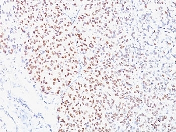 MITF Antibody - Formalin-fixed, paraffin-embedded human melanoma stained with MITF antibody (D5).  This image was taken for the unmodified form of this product. Other forms have not been tested.