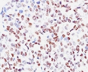 MITF Antibody - Formalin-fixed, paraffin-embedded human melanoma stained with anti-MITF antibody (SPM290).  This image was taken for the unmodified form of this product. Other forms have not been tested.