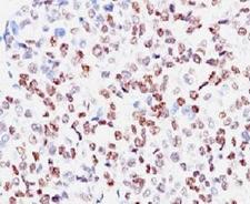 MITF Antibody - Formalin-fixed, paraffin-embedded human melanoma stained with anti-MITF antibody (SPM290).  This image was taken for the unmodified form of this product. Other forms have not been tested.