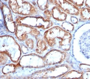 Mitochondria Antibody - IHC testing of renal cell carcinoma and Mitochondrial Marker antibody (113-1). This image was taken for the unmodified form of this product. Other forms have not been tested.