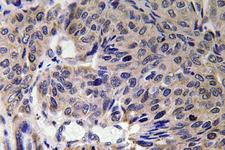 Mitofusin 2 / MFN2 Antibody - Immunohistochemistry analysis of Mfn2 antibody in paraffin-embedded human lung carcinoma tissue.