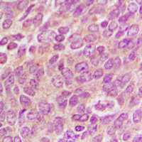 Mitofusin 2 / MFN2 Antibody - Immunohistochemical analysis of MFN2 staining in human breast cancer formalin fixed paraffin embedded tissue section. The section was pre-treated using heat mediated antigen retrieval with sodium citrate buffer (pH 6.0). The section was then incubated with the antibody at room temperature and detected using an HRP conjugated compact polymer system. DAB was used as the chromogen. The section was then counterstained with hematoxylin and mounted with DPX.