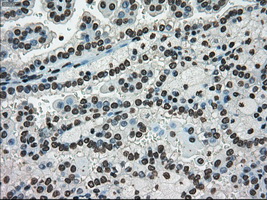 MKI67 / Ki67 Antibody - Immunohistochemical staining of paraffin-embedded Carcinoma of kidney tissue using anti-MKI67 mouse monoclonal antibody. (Dilution 1:50).