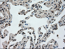 MKI67 / Ki67 Antibody - Immunohistochemical staining of paraffin-embedded Carcinoma of lung tissue using anti-MKI67 mouse monoclonal antibody. (Dilution 1:50).