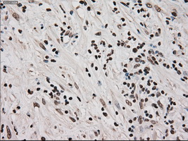 MKI67 / Ki67 Antibody - Immunohistochemical staining of paraffin-embedded Carcinoma of pancreas tissue using anti-MKI67 mouse monoclonal antibody. (Dilution 1:50).