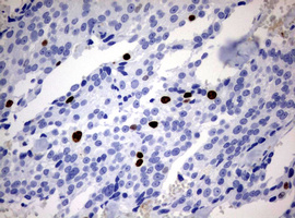 MKI67 / Ki67 Antibody - IHC of paraffin-embedded Adenocarcinoma of Human breast tissue using anti-MKI67 mouse monoclonal antibody. (Heat-induced epitope retrieval by 10mM citric buffer, pH6.0, 120°C for 3min).