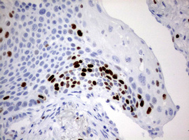 MKI67 / Ki67 Antibody - IHC of paraffin-embedded Carcinoma of Human lung tissue using anti-MKI67 mouse monoclonal antibody. (Heat-induced epitope retrieval by 10mM citric buffer, pH6.0, 120°C for 3min).