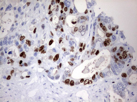 MKI67 / Ki67 Antibody - IHC of paraffin-embedded Adenocarcinoma of Human colon tissue using anti-MKI67 mouse monoclonal antibody. (Heat-induced epitope retrieval by 10mM citric buffer, pH6.0, 120°C for 3min).