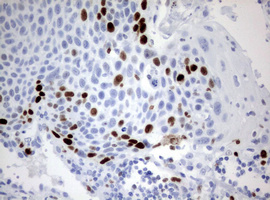 MKI67 / Ki67 Antibody - IHC of paraffin-embedded Carcinoma of Human lung tissue using anti-MKI67 mouse monoclonal antibody. (Heat-induced epitope retrieval by 10mM citric buffer, pH6.0, 120°C for 3min).