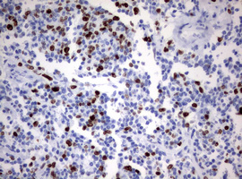 MKI67 / Ki67 Antibody - IHC of paraffin-embedded Human lymphoma tissue using anti-MKI67 mouse monoclonal antibody. (Heat-induced epitope retrieval by 10mM citric buffer, pH6.0, 120°C for 3min).