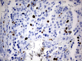 MKI67 / Ki67 Antibody - IHC of paraffin-embedded Adenocarcinoma of Human breast tissue using anti-MKI67 mouse monoclonal antibody. (Heat-induced epitope retrieval by 10mM citric buffer, pH6.0, 120°C for 3min).