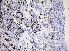 MKI67 / Ki67 Antibody - IHC of paraffin-embedded Human lymph node tissue using anti-MKI67 mouse monoclonal antibody. (Heat-induced epitope retrieval by 10mM citric buffer, pH6.0, 120°C for 3min).