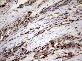 MKI67 / Ki67 Antibody - IHC of paraffin-embedded Adenocarcinoma of Human endometrium tissue using anti-MKI67 mouse monoclonal antibody. (Heat-induced epitope retrieval by 10mM citric buffer, pH6.0, 120°C for 3min).