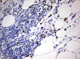 MKI67 / Ki67 Antibody - IHC of paraffin-embedded Carcinoma of Human bladder tissue using anti-MKI67 mouse monoclonal antibody. (Heat-induced epitope retrieval by 10mM citric buffer, pH6.0, 120°C for 3min).