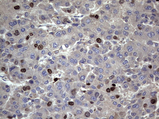 MKI67 / Ki67 Antibody - IHC of paraffin-embedded Carcinoma of Human liver tissue using anti-MKI67 rat monoclonal antibody. (heat-induced epitope retrieval by 1 mM EDTA in 10mM Tris, pH8.5, 120°C for 3min).