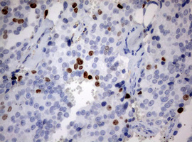 MKI67 / Ki67 Antibody - IHC of paraffin-embedded Adenocarcinoma of Human breast tissue using anti-MKI67 mouse monoclonal antibody. (Heat-induced epitope retrieval by 10mM citric buffer, pH6.0, 120°C for 3min).