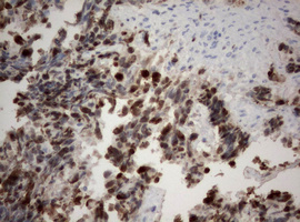 MKI67 / Ki67 Antibody - IHC of paraffin-embedded Adenocarcinoma of Human endometrium tissue using anti-MKI67 mouse monoclonal antibody. (Heat-induced epitope retrieval by 10mM citric buffer, pH6.0, 120°C for 3min).