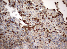 MKI67 / Ki67 Antibody - IHC of paraffin-embedded Human lymph node tissue using anti-MKI67 mouse monoclonal antibody. (Heat-induced epitope retrieval by 10mM citric buffer, pH6.0, 120°C for 3min).