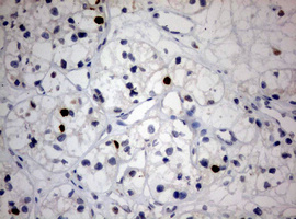 MKI67 / Ki67 Antibody - IHC of paraffin-embedded Carcinoma of Human kidney tissue using anti-MKI67 mouse monoclonal antibody. (Heat-induced epitope retrieval by 10mM citric buffer, pH6.0, 120°C for 3min).