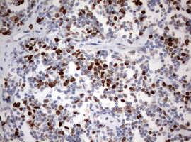 MKI67 / Ki67 Antibody - IHC of paraffin-embedded Human lymphoma tissue using anti-MKI67 mouse monoclonal antibody. (Heat-induced epitope retrieval by 10mM citric buffer, pH6.0, 120°C for 3min).