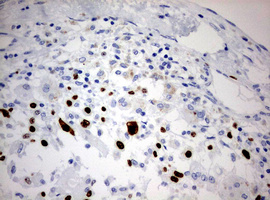 MKI67 / Ki67 Antibody - IHC of paraffin-embedded Carcinoma of Human liver tissue using anti-MKI67 mouse monoclonal antibody. (Heat-induced epitope retrieval by 10mM citric buffer, pH6.0, 120°C for 3min).