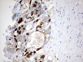 MKI67 / Ki67 Antibody - IHC of paraffin-embedded Adenocarcinoma of Human colon tissue using anti-MKI67 mouse monoclonal antibody. (Heat-induced epitope retrieval by 10mM citric buffer, pH6.0, 120°C for 3min).