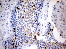 MKI67 / Ki67 Antibody - IHC of paraffin-embedded Carcinoma of Human lung tissue using anti-MKI67 mouse monoclonal antibody. (Heat-induced epitope retrieval by 10mM citric buffer, pH6.0, 120°C for 3min).