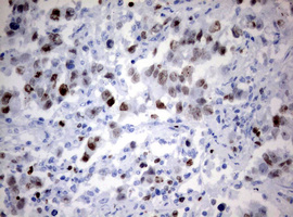 MKI67 / Ki67 Antibody - IHC of paraffin-embedded Adenocarcinoma of Human endometrium tissue using anti-MKI67 mouse monoclonal antibody. (Heat-induced epitope retrieval by 10mM citric buffer, pH6.0, 120°C for 3min).