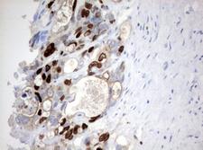 MKI67 / Ki67 Antibody - IHC of paraffin-embedded Adenocarcinoma of Human colon tissue using anti-MKI67 mouse monoclonal antibody. (Heat-induced epitope retrieval by 10mM citric buffer, pH6.0, 120°C for 3min).