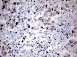 MKI67 / Ki67 Antibody - IHC of paraffin-embedded Adenocarcinoma of Human ovary tissue using anti-MKI67 mouse monoclonal antibody. (Heat-induced epitope retrieval by 10mM citric buffer, pH6.0, 120°C for 3min).