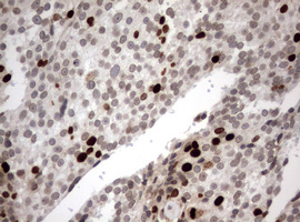 MKI67 / Ki67 Antibody - IHC of paraffin-embedded Adenocarcinoma of Human breast tissue using anti-MKI67 mouse monoclonal antibody. (Heat-induced epitope retrieval by 10mM citric buffer, pH6.0, 120°C for 3min).