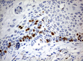 MKI67 / Ki67 Antibody - IHC of paraffin-embedded Carcinoma of Human lung tissue using anti-MKI67 mouse monoclonal antibody. (Heat-induced epitope retrieval by 10mM citric buffer, pH6.0, 120°C for 3min).