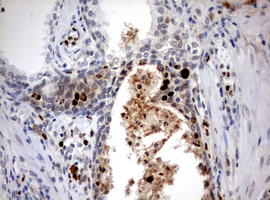 MKI67 / Ki67 Antibody - IHC of paraffin-embedded Human prostate tissue using anti-MKI67 mouse monoclonal antibody. (Heat-induced epitope retrieval by 10mM citric buffer, pH6.0, 120°C for 3min).
