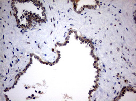 MKI67 / Ki67 Antibody - IHC of paraffin-embedded Carcinoma of Human prostate tissue using anti-MKI67 mouse monoclonal antibody. (Heat-induced epitope retrieval by 10mM citric buffer, pH6.0, 120°C for 3min).