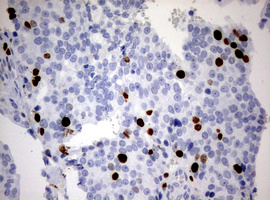 MKI67 / Ki67 Antibody - IHC of paraffin-embedded Adenocarcinoma of Human breast tissue using anti-MKI67 mouse monoclonal antibody. (Heat-induced epitope retrieval by 10mM citric buffer, pH6.0, 120°C for 3min).