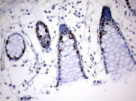 MKI67 / Ki67 Antibody - IHC of paraffin-embedded Human colon tissue using anti-MKI67 mouse monoclonal antibody. (Heat-induced epitope retrieval by 10mM citric buffer, pH6.0, 120°C for 3min).