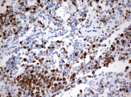 MKI67 / Ki67 Antibody - IHC of paraffin-embedded Human lymphoma tissue using anti-MKI67 mouse monoclonal antibody. (Heat-induced epitope retrieval by 10mM citric buffer, pH6.0, 120°C for 3min).