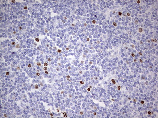 MKI67 / Ki67 Antibody - IHC of paraffin-embedded Human lymphoma tissue using anti-MKI67 rat monoclonal antibody. (heat-induced epitope retrieval by 1 mM EDTA in 10mM Tris, pH8.5, 120°C for 3min).