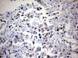 MKI67 / Ki67 Antibody - IHC of paraffin-embedded Adenocarcinoma of Human ovary tissue using anti-MKI67 mouse monoclonal antibody. (Heat-induced epitope retrieval by 10mM citric buffer, pH6.0, 120°C for 3min).