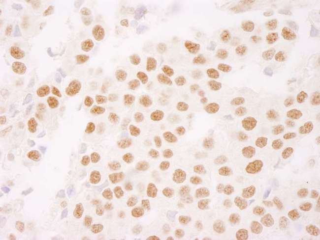 MKI67 / Ki67 Antibody - Detection of Human Ki-67 by Immunohistochemistry. Sample: FFPE section of human breast carcinoma. Antibody: Affinity purified rabbit anti-Ki-67 used at a dilution of 1:250. Epitope Retrieval Buffer-High pH (IHC-101J) was substituted for Epitope Retrieval Buffer-Reduced pH.