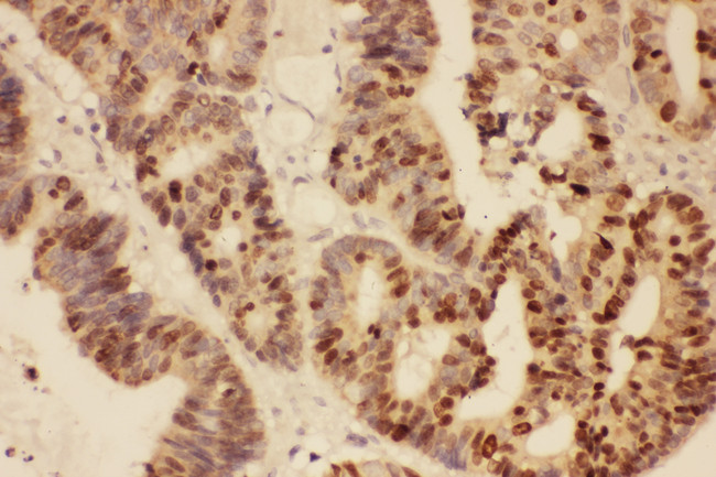MKI67 / Ki67 Antibody - MKI67 / Ki67 antibody. IHC(P): Human Intestinal Cancer Tissue.
