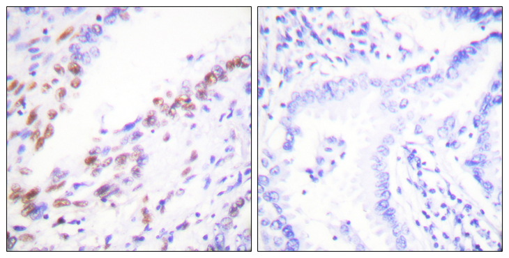 MKI67 / Ki67 Antibody - Immunohistochemistry analysis of paraffin-embedded human lung carcinoma tissue, using Ki67 Antibody. The picture on the right is blocked with the synthesized peptide.