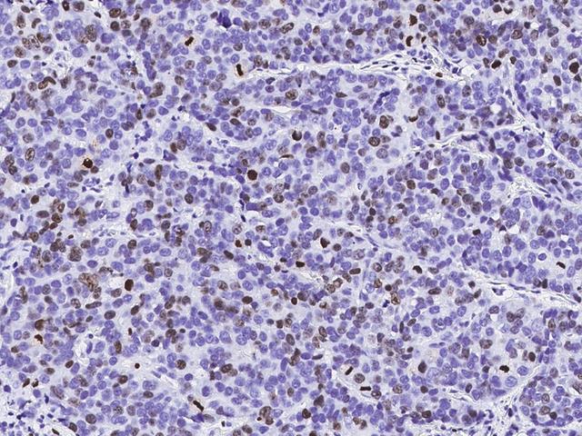 MKI67 / Ki67 Antibody - Immunochemical staining of human KI-67 in human breast carcinoma with mouse monoclonal antibody (1:1000, formalin-fixed paraffin embedded sections).
