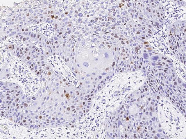 MKI67 / Ki67 Antibody - Immunochemical staining of human KI-67 in human esophageal carcinoma with mouse monoclonal antibody (1:1000, formalin-fixed paraffin embedded sections).