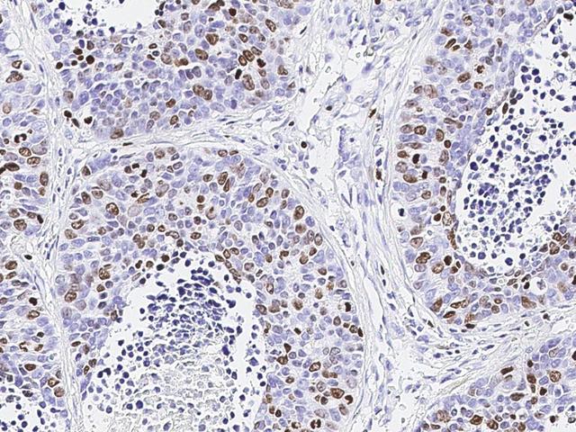 MKI67 / Ki67 Antibody - Immunochemical staining of human KI-67 in human lung cancer with mouse monoclonal antibody (1:1000, formalin-fixed paraffin embedded sections).
