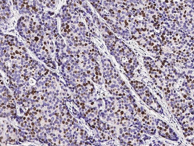 MKI67 / Ki67 Antibody - Immunochemical staining of human KI-67 in human breast carcinoma with mouse monoclonal antibody (1:200, formalin-fixed paraffin embedded sections).