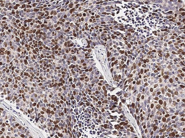 MKI67 / Ki67 Antibody - Immunochemical staining of human KI-67 in human lung cancer with mouse monoclonal antibody (1:200, formalin-fixed paraffin embedded sections).