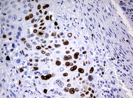 MKI67 / Ki67 Antibody - IHC of paraffin-embedded Carcinoma of Human lung tissue using anti-MKI67 mouse monoclonal antibody.