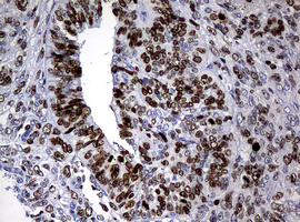 MKI67 / Ki67 Antibody - IHC of paraffin-embedded Adenocarcinoma of Human endometrium tissue using anti-MKI67 mouse monoclonal antibody.